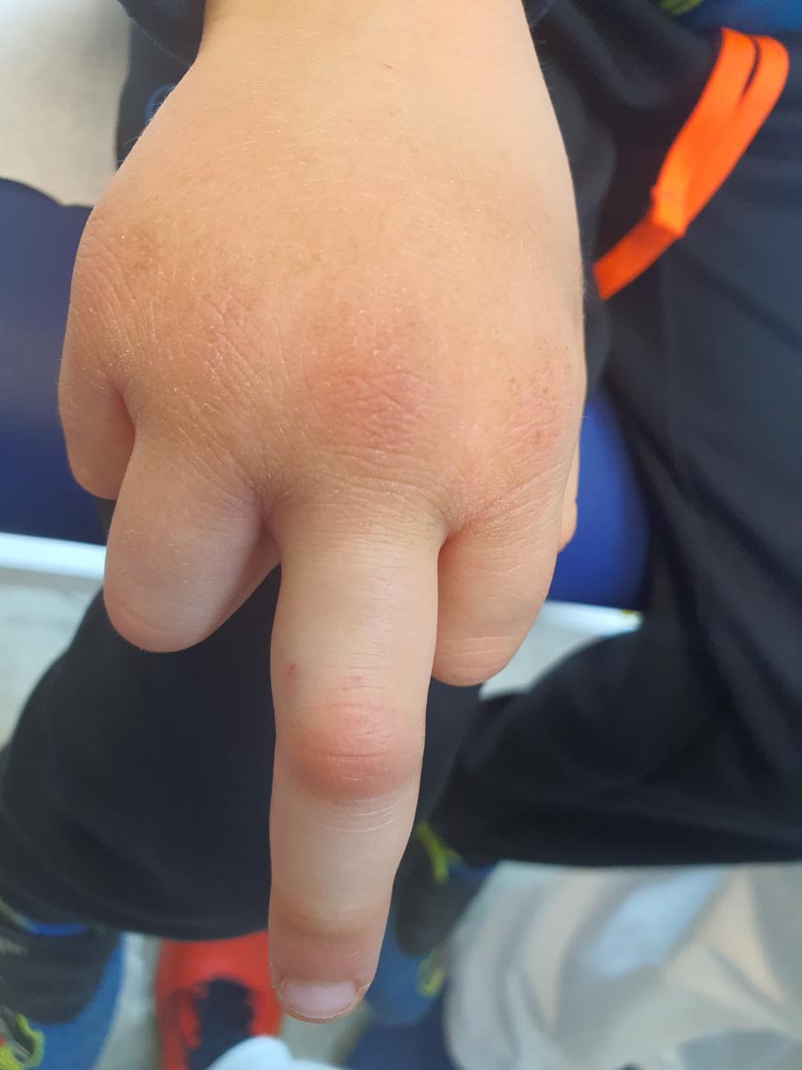 Il dito del bambino morso dalla vipera