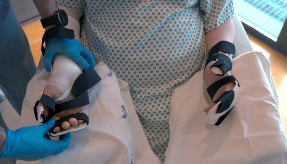 intervento mani amputate