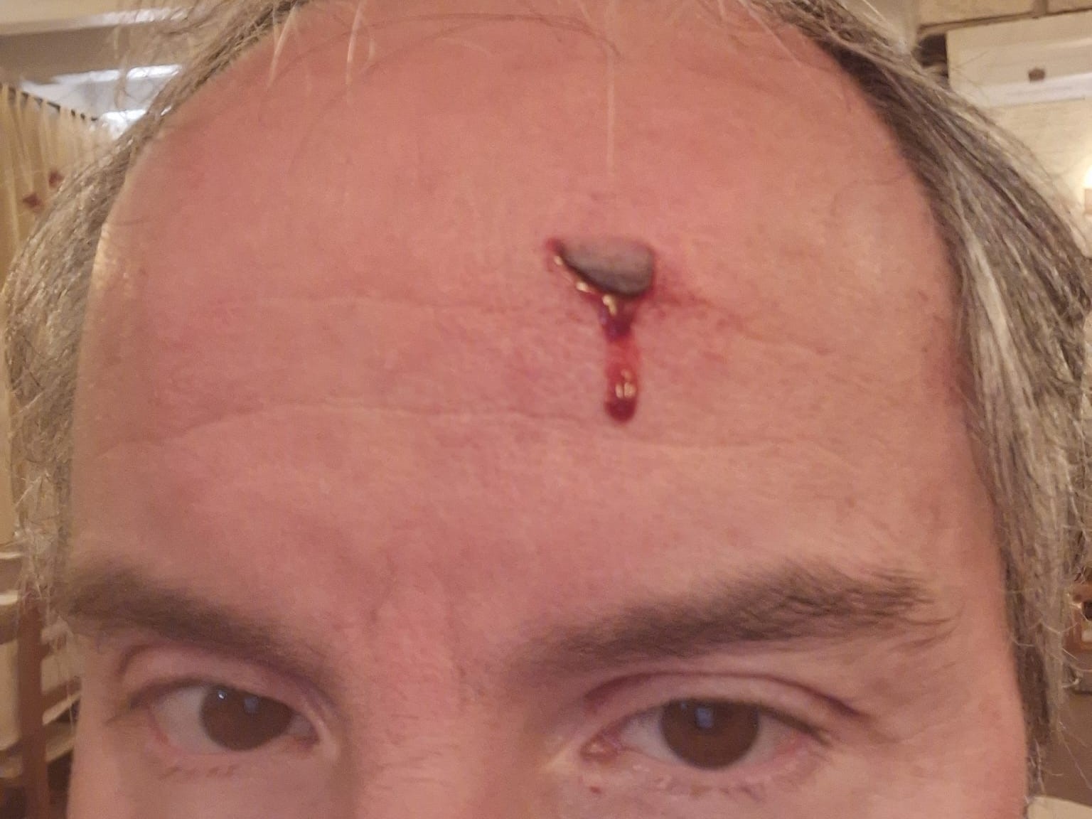 Davide Veneri mostra la ferita subita